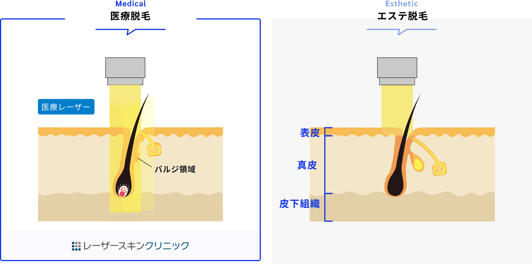 永久的な脱毛効果が期待できます