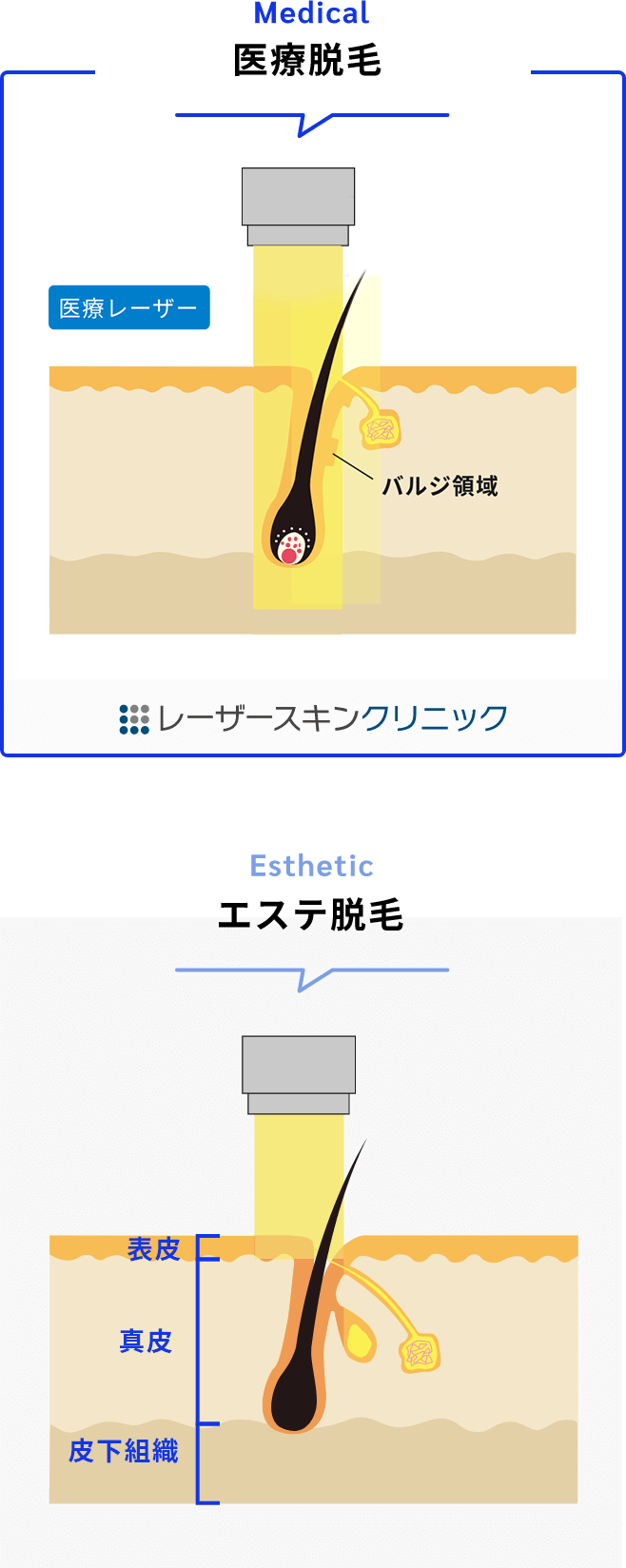 永久的な脱毛効果が期待できます