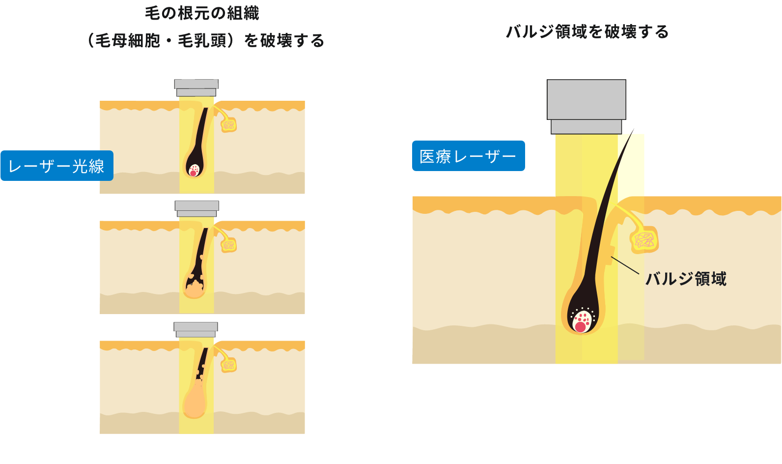 医療用のレーザー