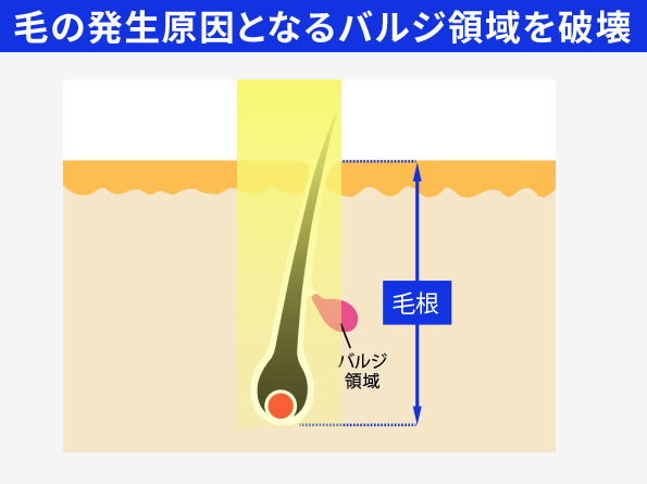 医療脱毛機