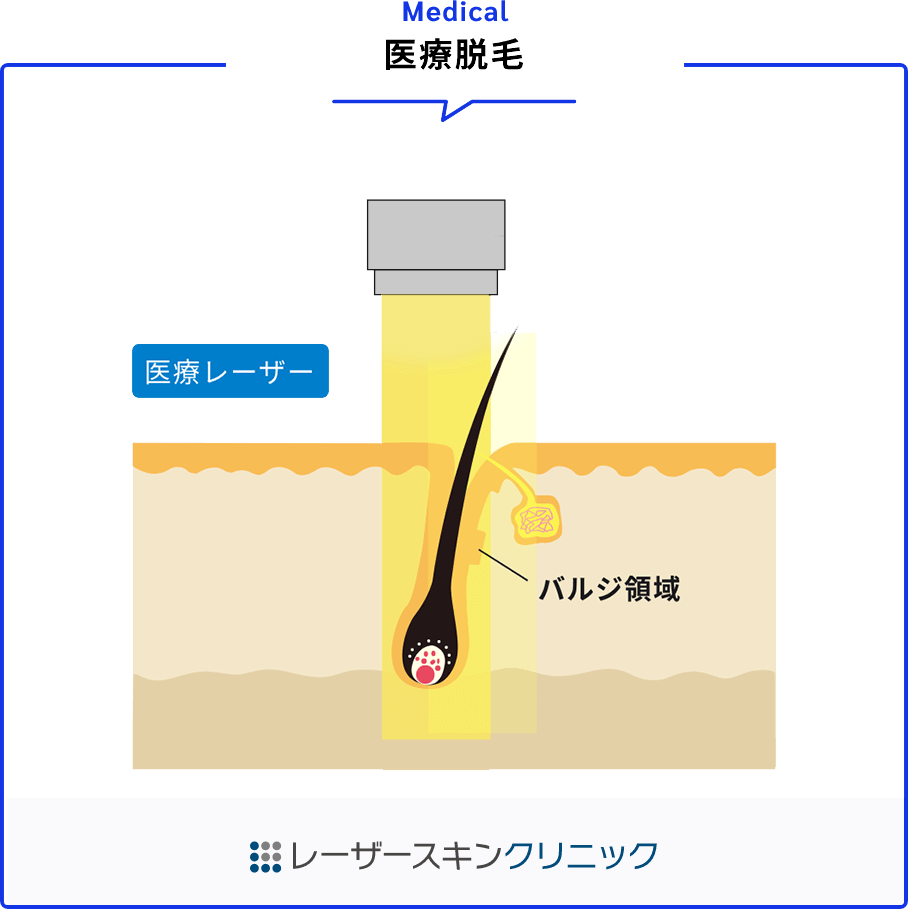 レーザーが毛を破壊するイラスト