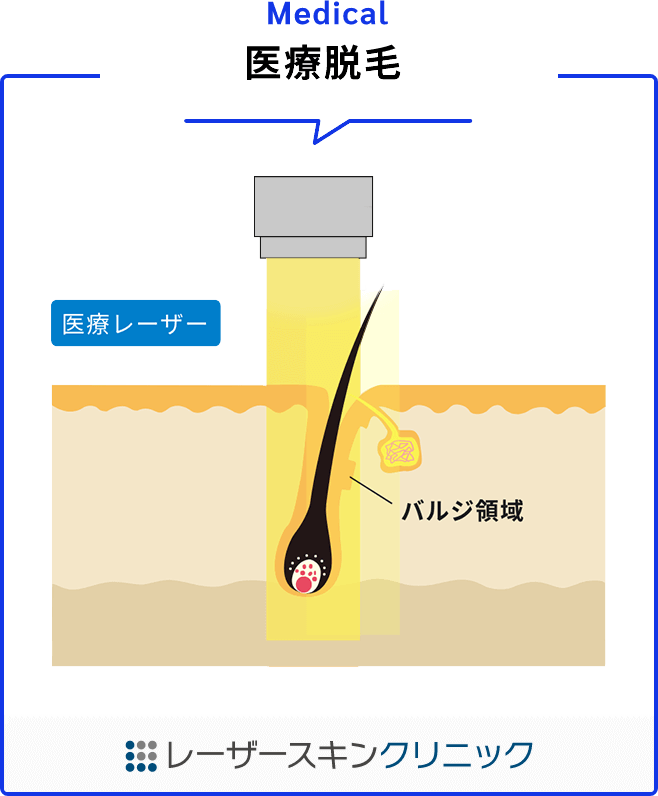 レーザーが毛を破壊するイラスト