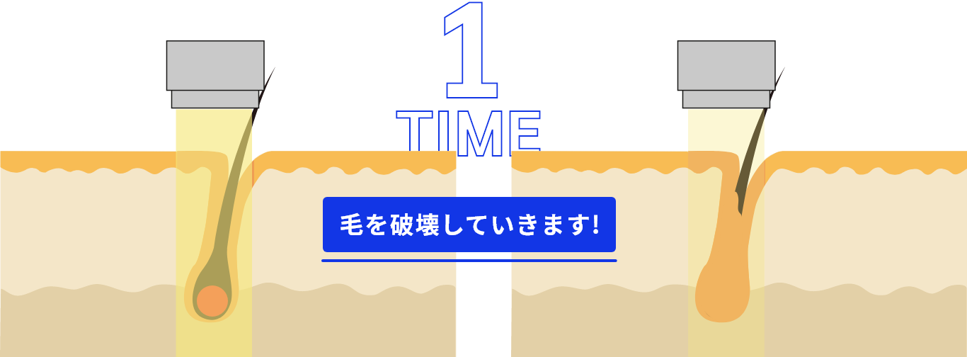 レーザーが毛を破壊するイラスト