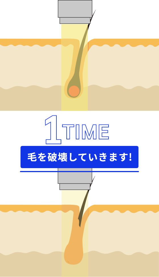 レーザーが毛を破壊するイラスト