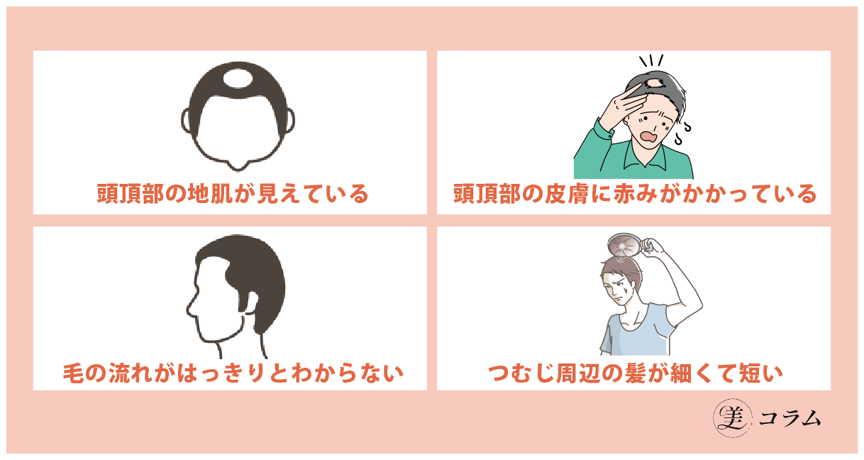 つむじはげは思い込み？見分け方の基準4つ